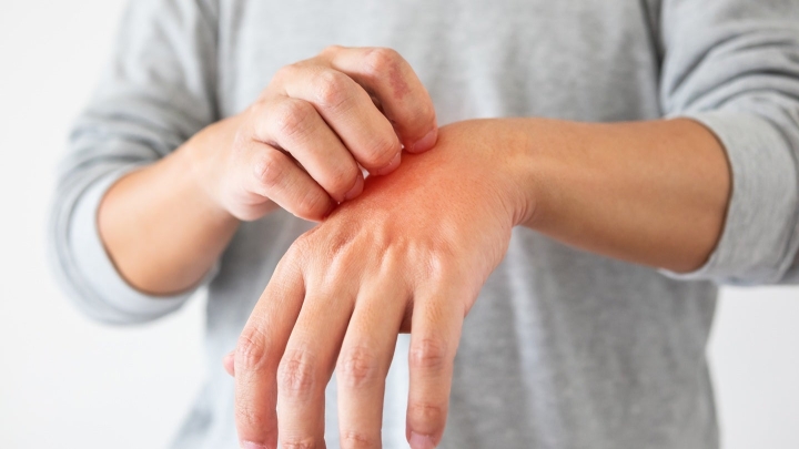 Kymera Therapeutics приступила к дозированию в IIb фазе КИ KT-621 при атопическом дерматите