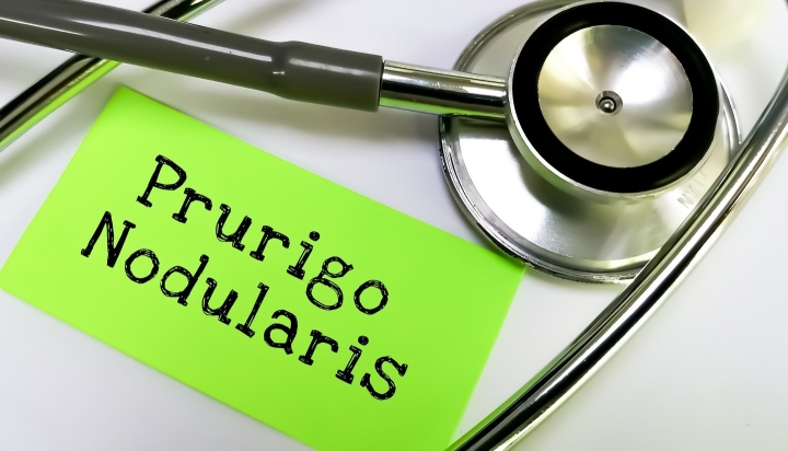 InnoCare начинает фазу II клинических испытаний soficitinib при пруриго нодулярис